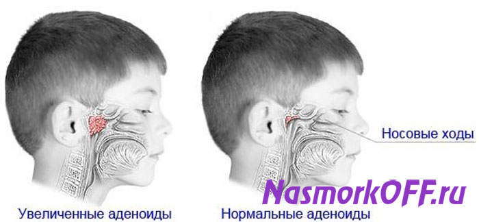 Аденоиды у детей