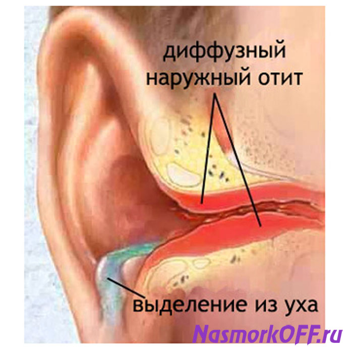 Диффузный отит у взрослого