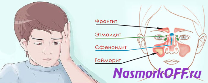 Фронтит и гайморит