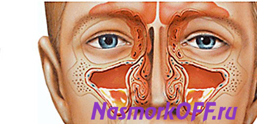 Двусторонний гайморит