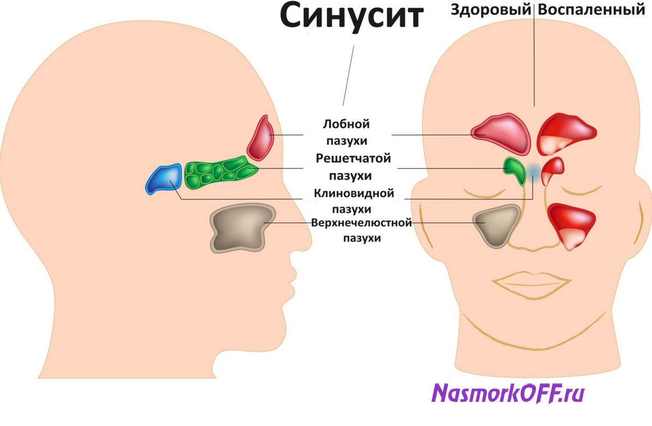 Схематичное изображение болезни пазух носа