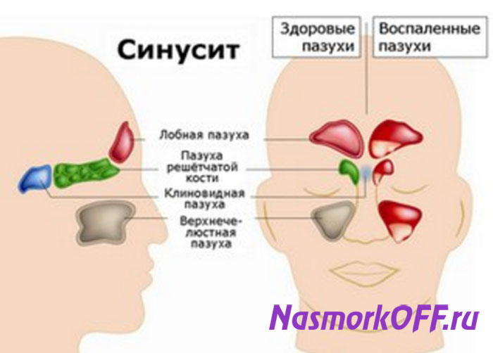 Синусит у детей