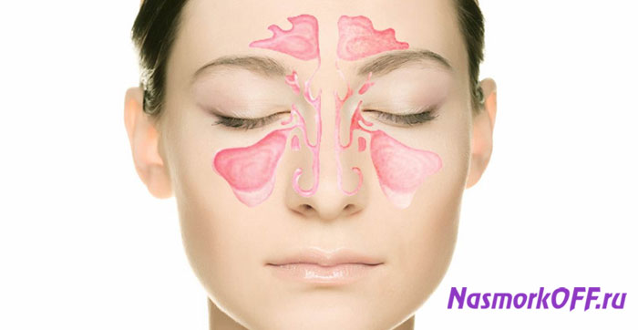 Воспалительный процесс в верхнечелюстной пазухе называется гайморитом. Данное заболевание уже давно знакомо человечеству