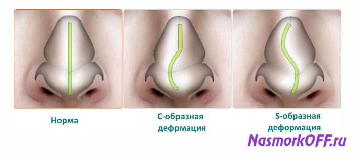 Искривление носовой перегородки