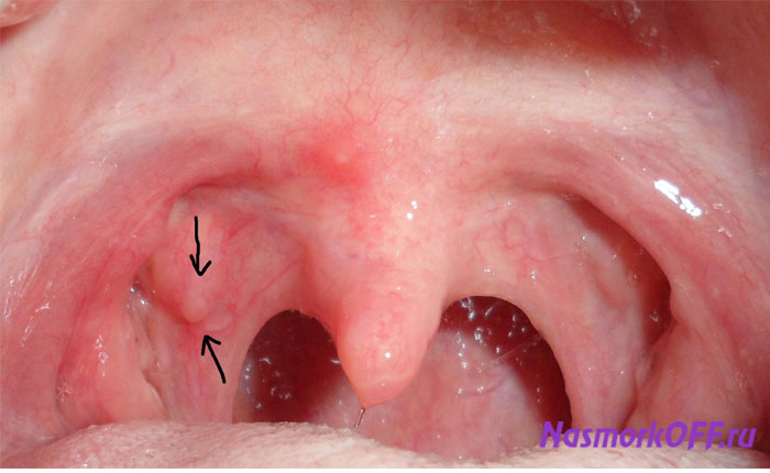 Припухлость лимфоузлов