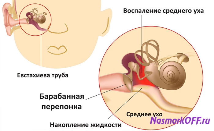 Средний Отит
