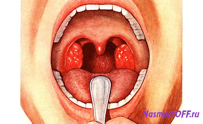 Воспалительный процесс слизистой глотки