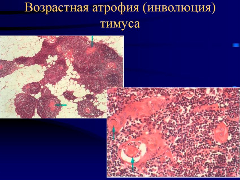 инволюция вилочковой железы