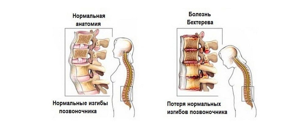 Болезнь Бехтерева: что это такое и как ее лечить