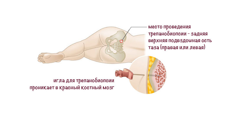 что такое трепанобиопсия костного мозга