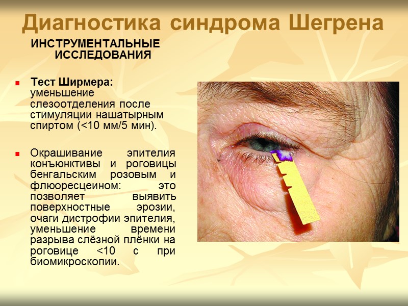 синдром шегрена