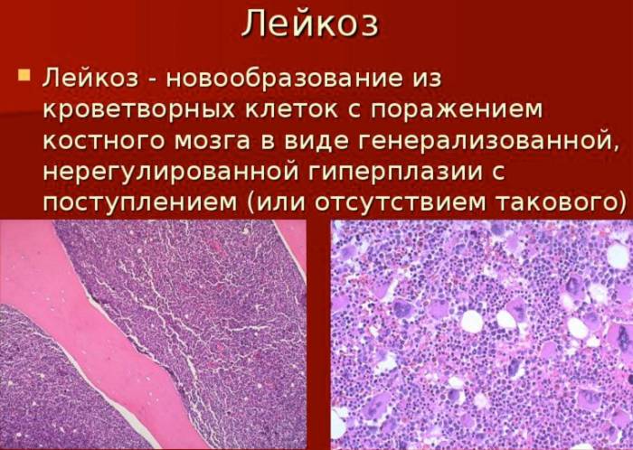 1 симптомы лейкоза у взрослых