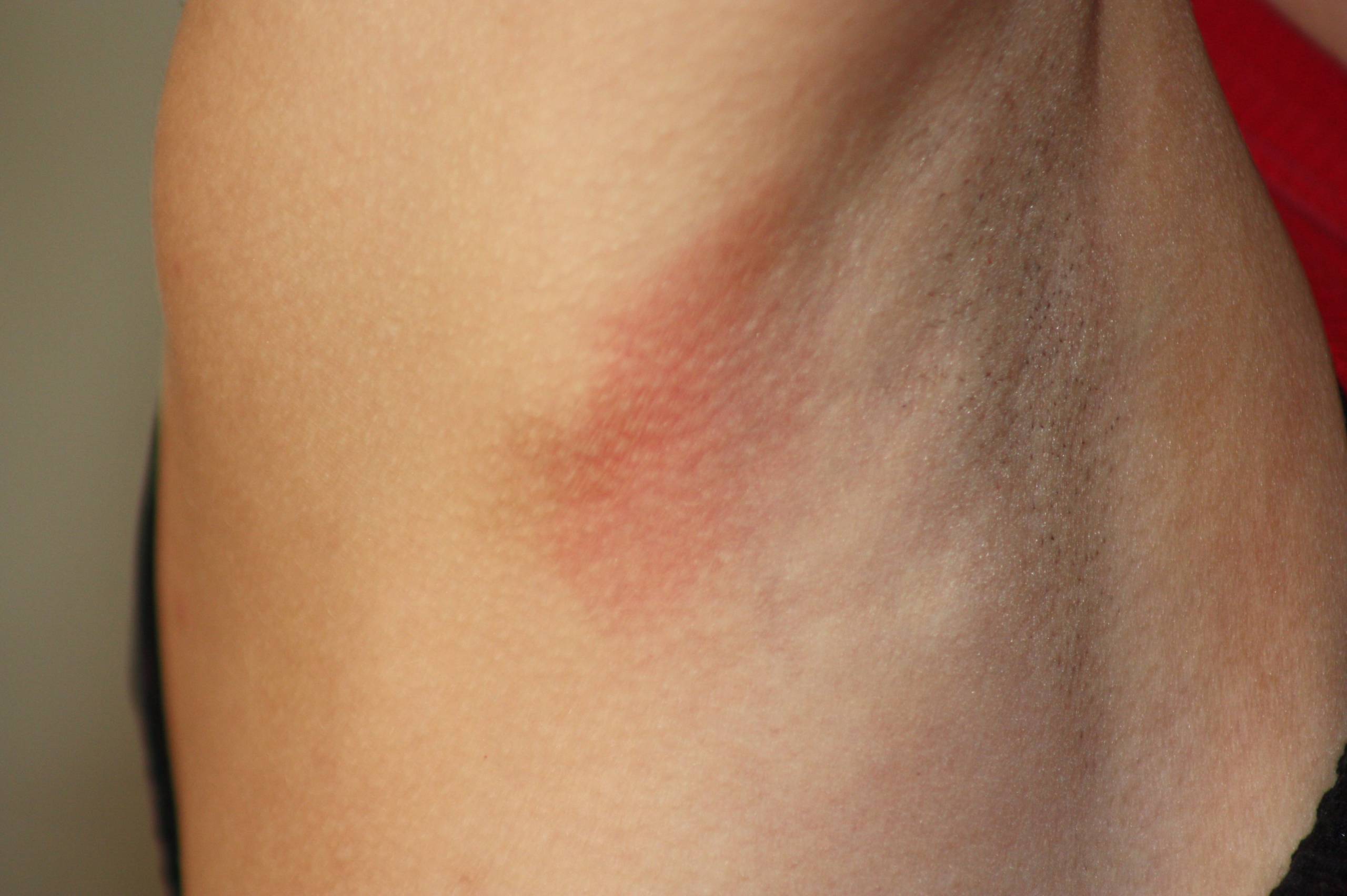 Аксиллярная лимфаденопатия Аксиллярная лимфаденопатия