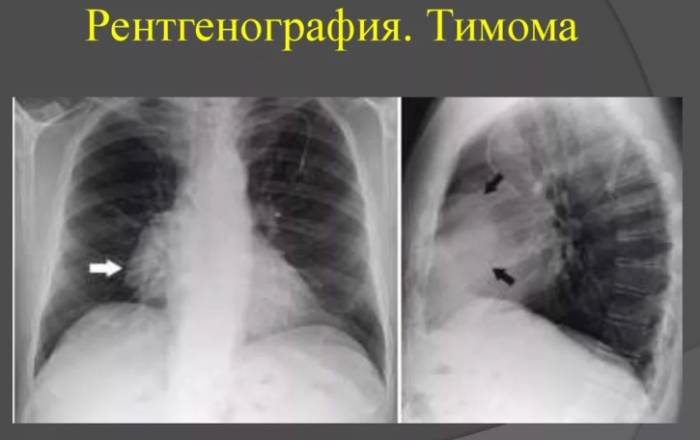 2 тимома вилочковой железы
