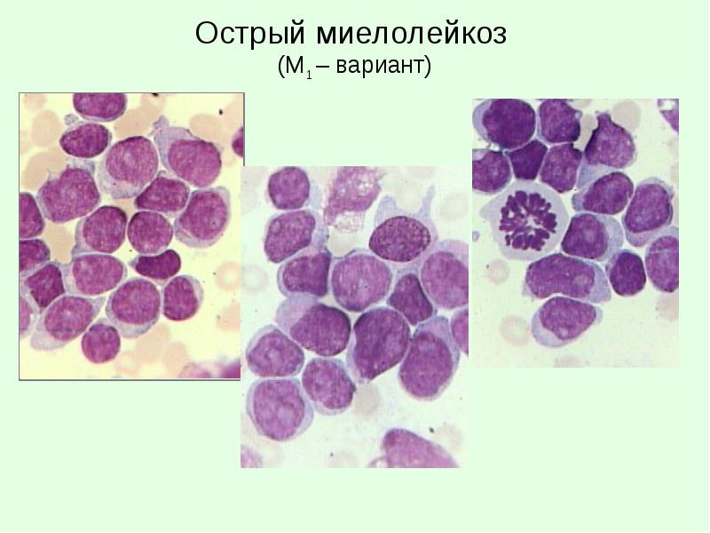2 что означает лейкоз
