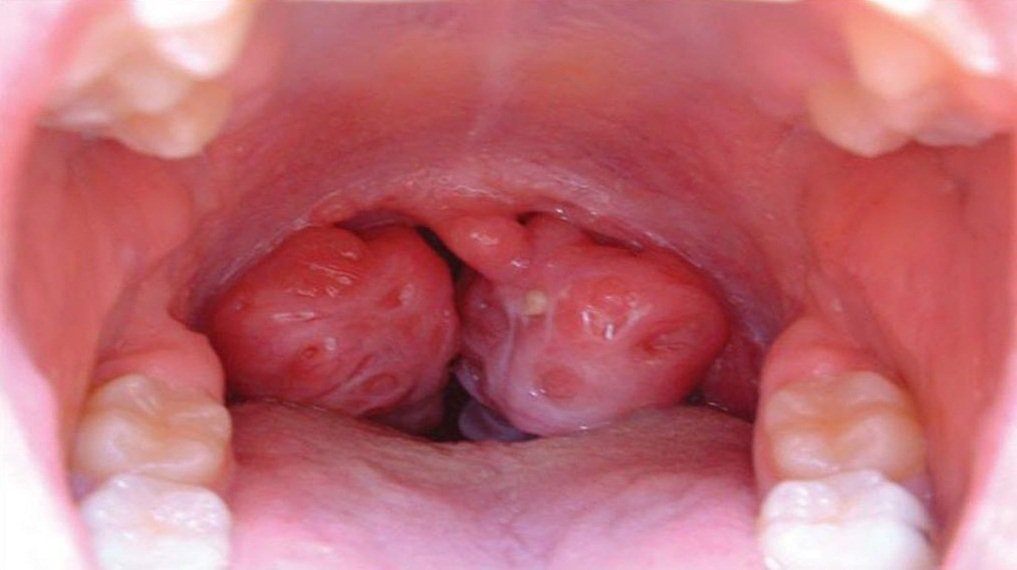 Дырки в гландах Дырки в гландах