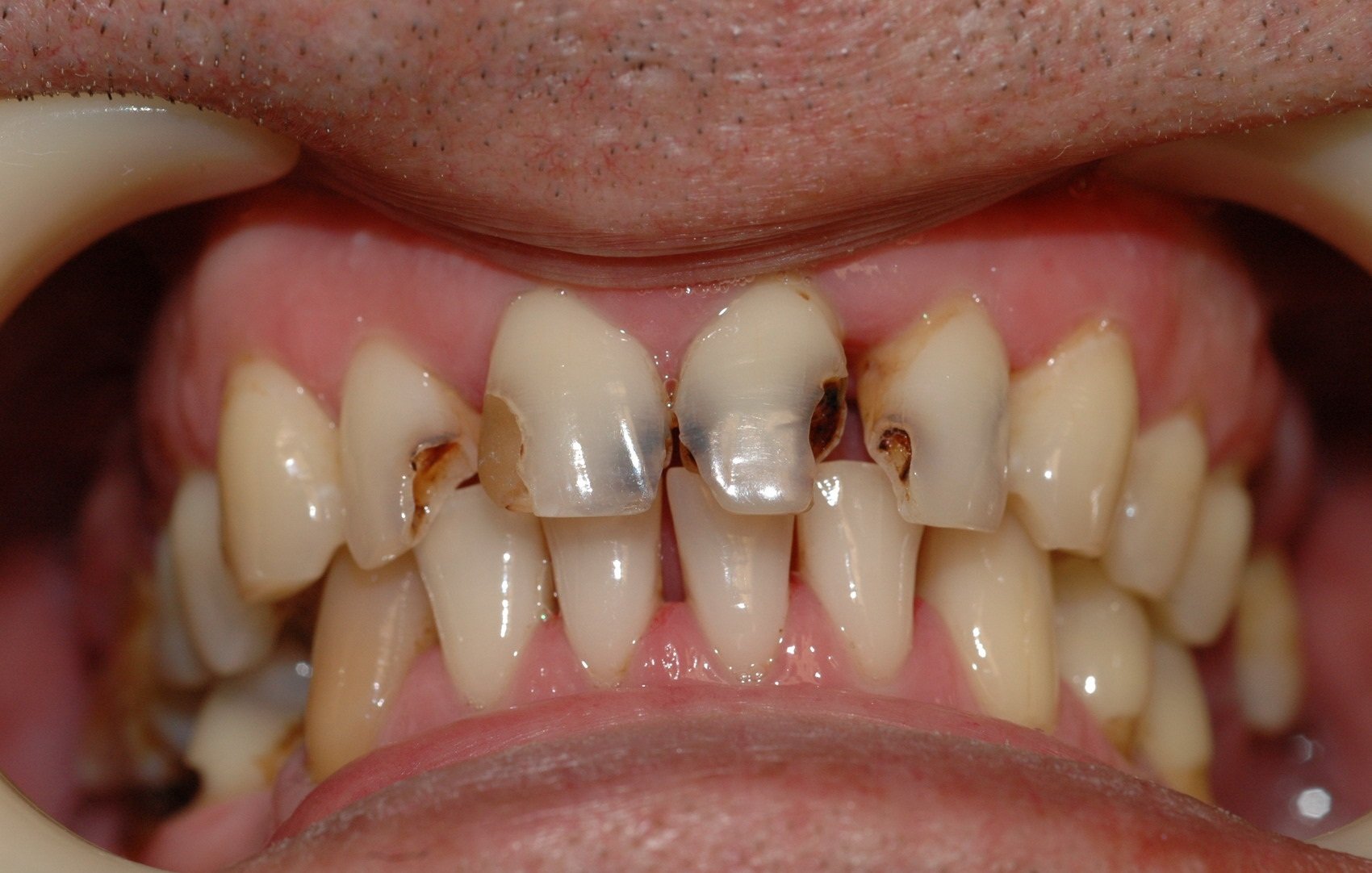 Причины появления гноя на миндалинах Причины появления гноя на миндалинах