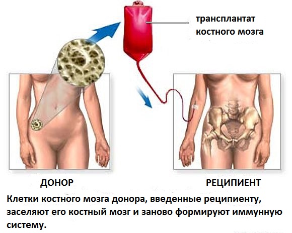 4 как происходит донорство костного мозга