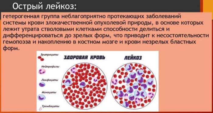 4 от чего лейкоз