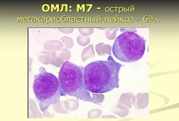 5 первые признаки лейкоза