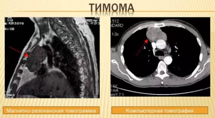 6 рак вилочковой железы