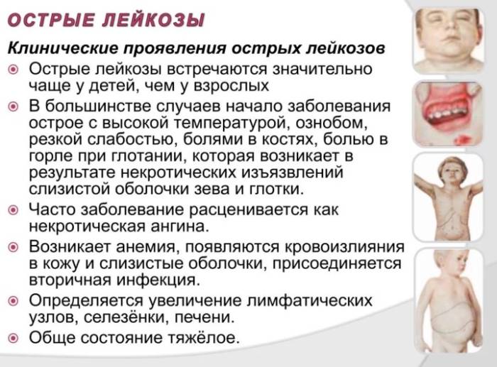 6 основные симптомы лейкоза