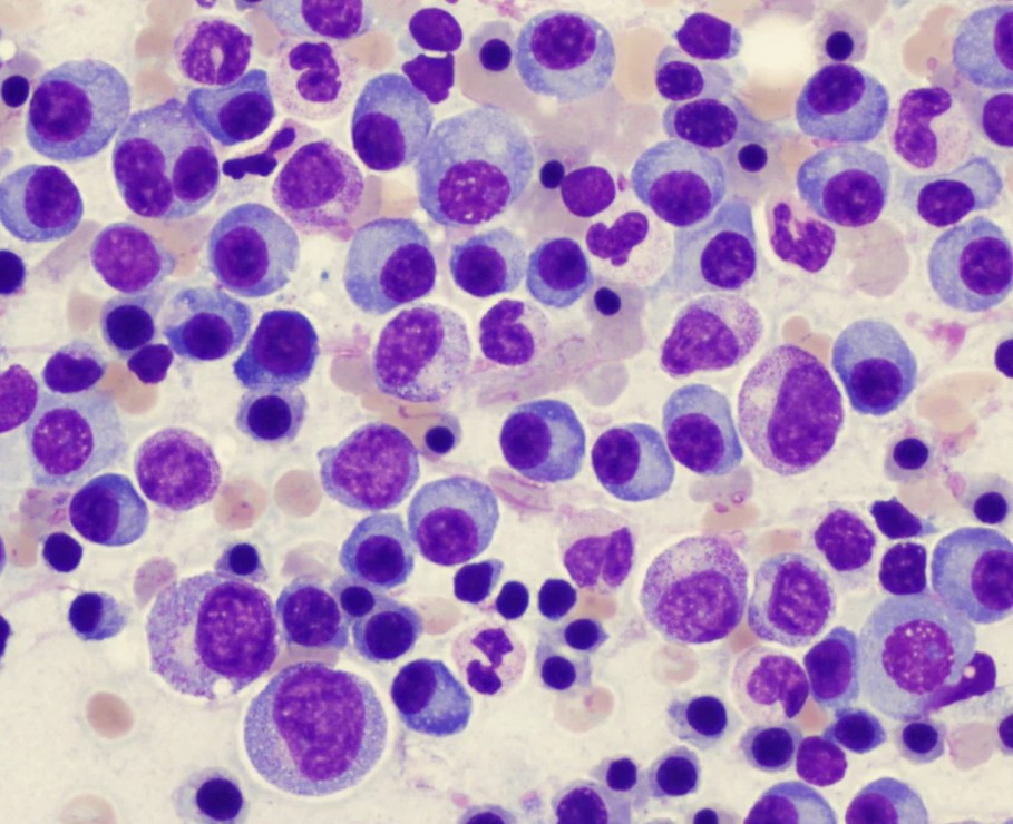 6 миеломная болезнь красного костного мозга