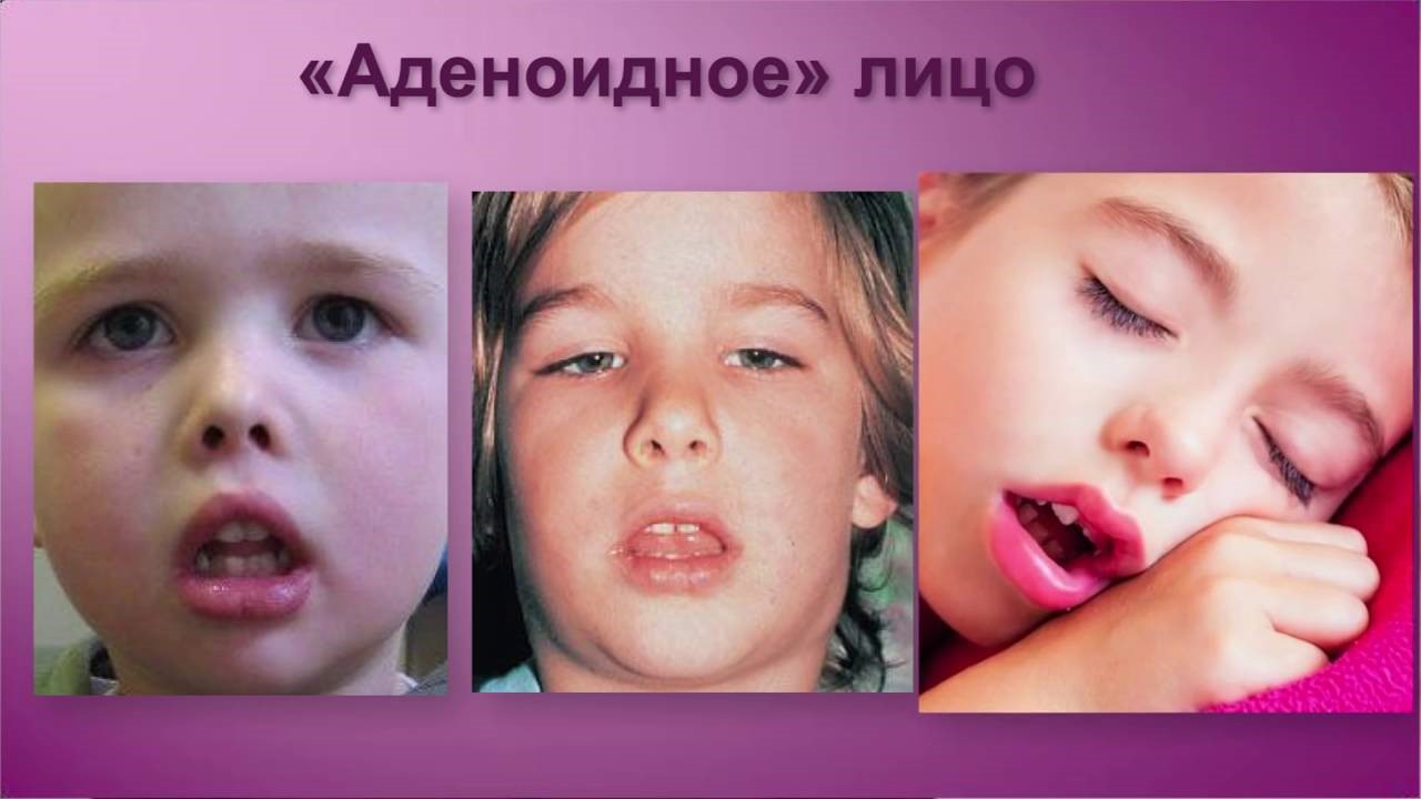 Симптомы аденоидов