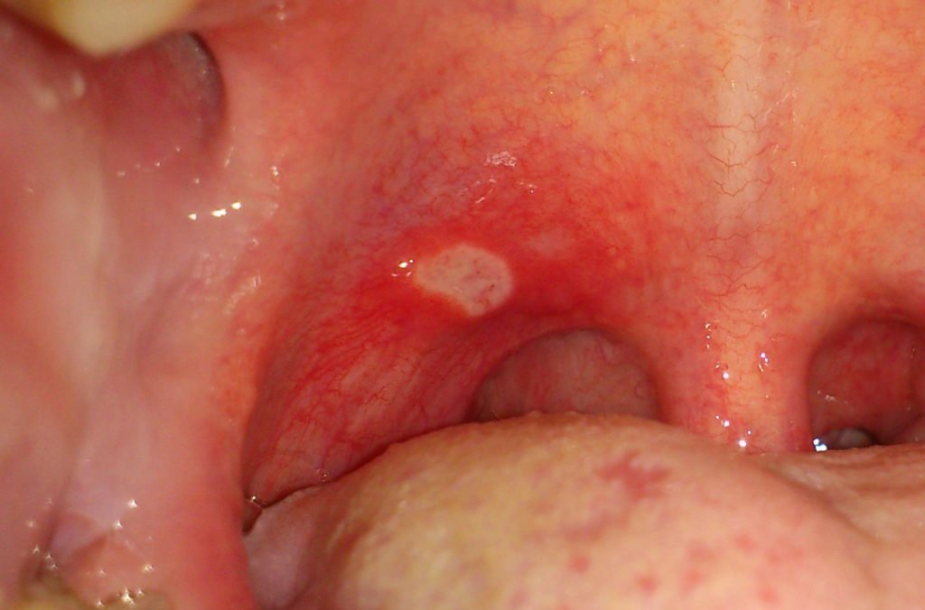 Стоматит на миндалинах Стоматит на миндалинах