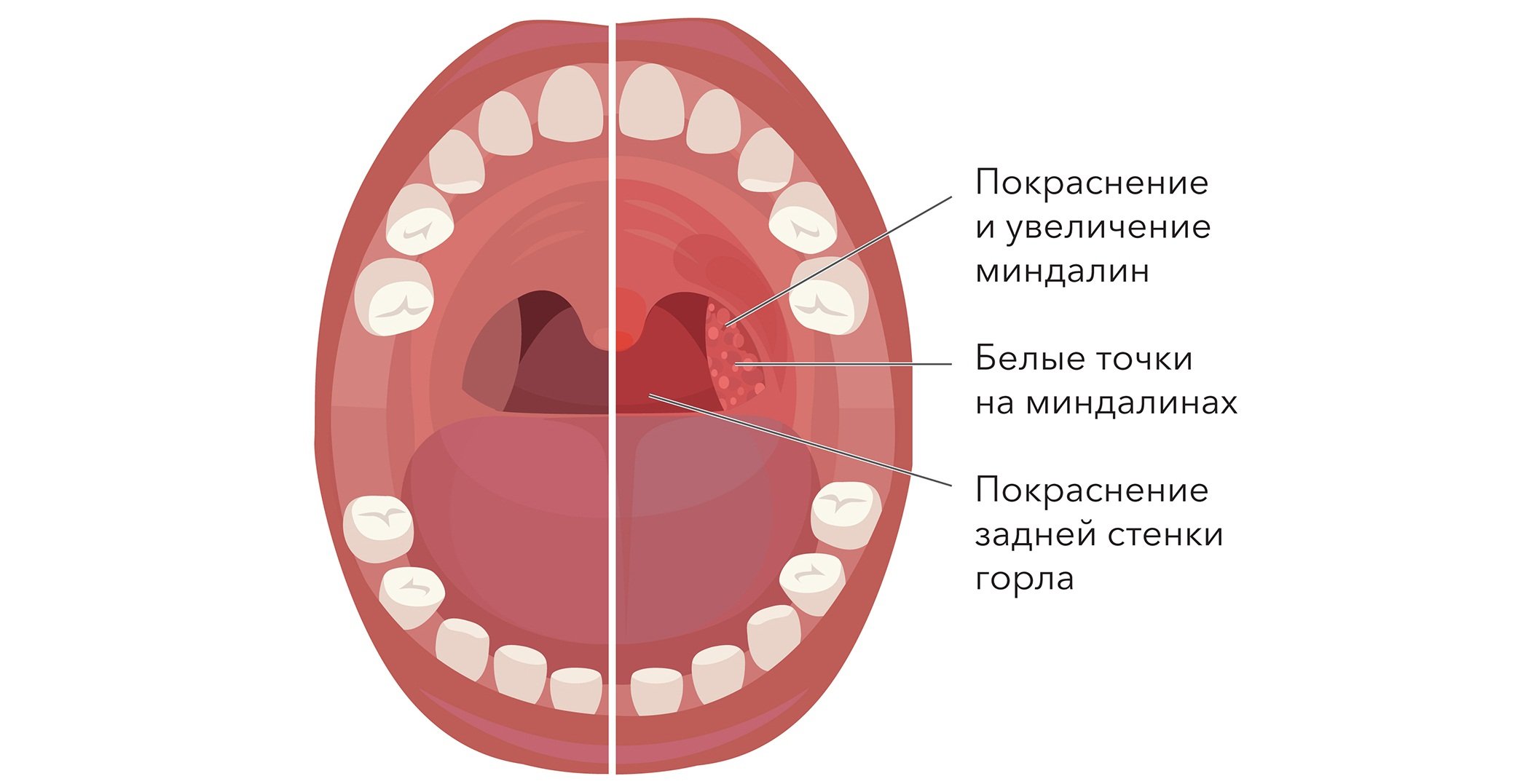 Неприятный запах изо рта из-за воспаления миндалин