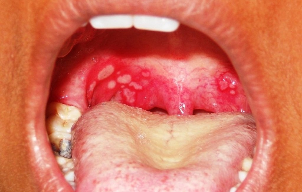 Симптомы гноя на миндалинах Симптомы гноя на миндалинах