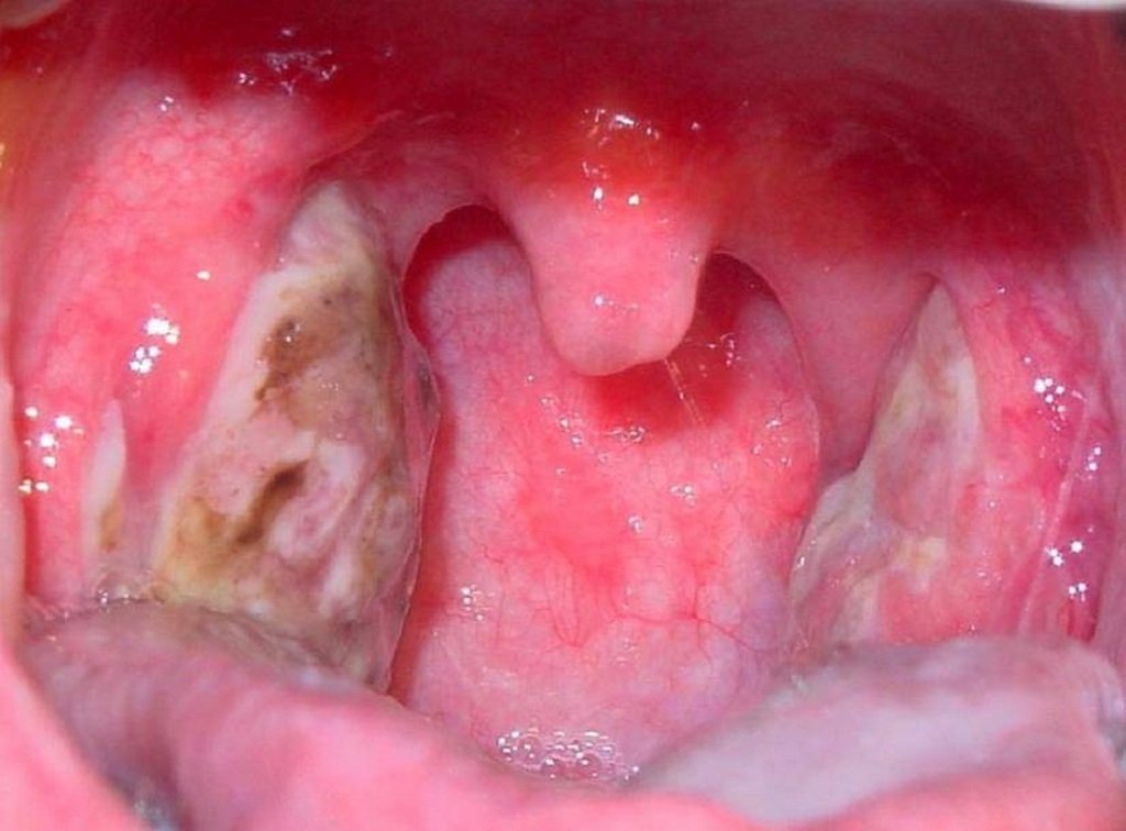 Причины появления язв на миндалинах Причины появления язв на миндалинах