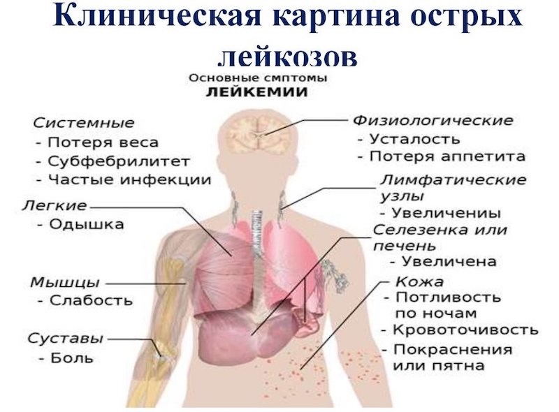 Острый лейкоз: прогноз для больного