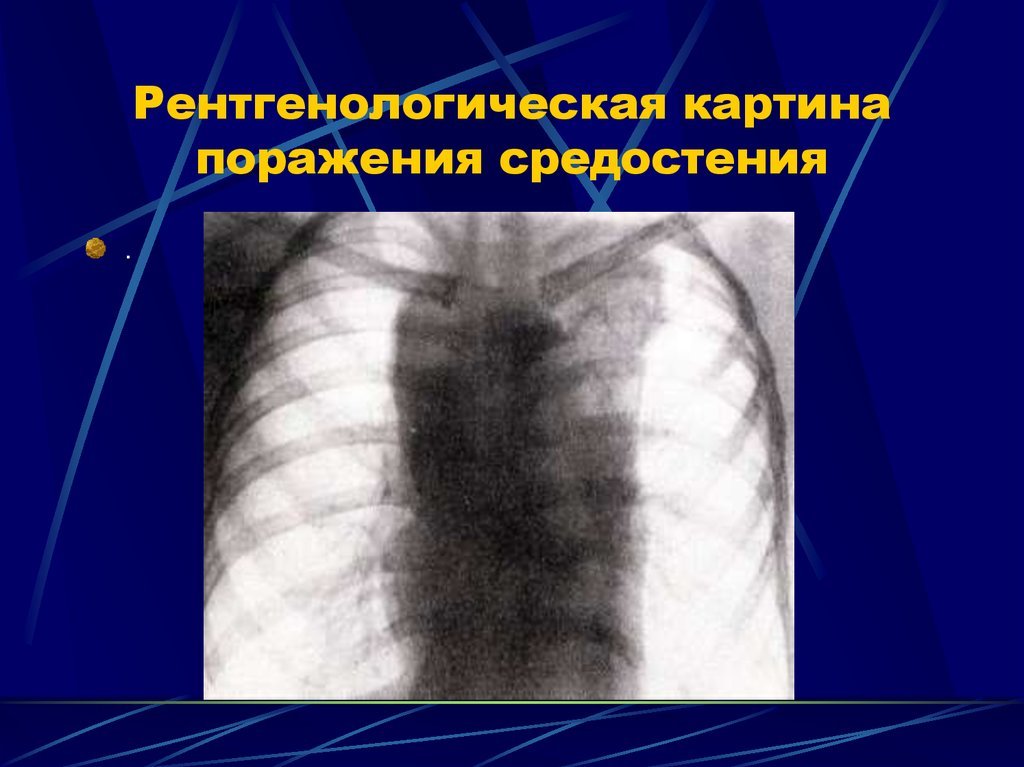 Лимфогранулематоз средостения Лимфогранулематоз средостения