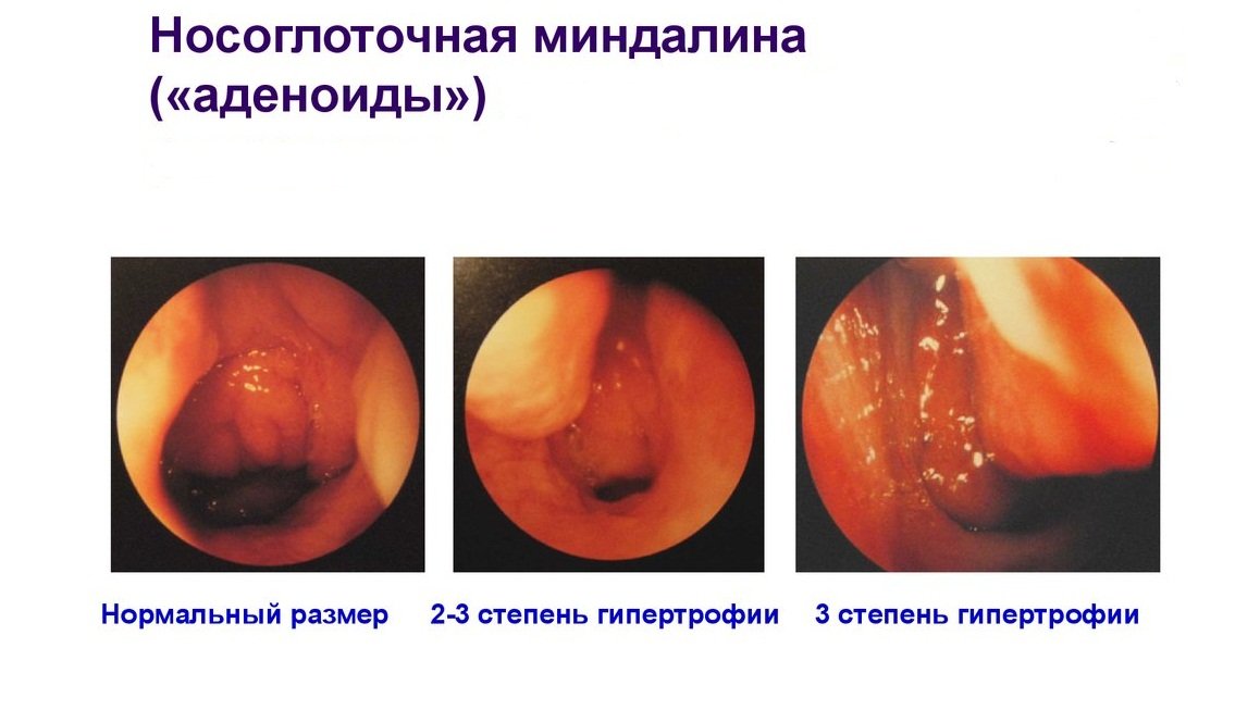 Формы и стадии аденоидита