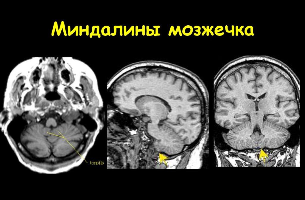 Расположение миндалин мозжечка Расположение миндалин мозжечка