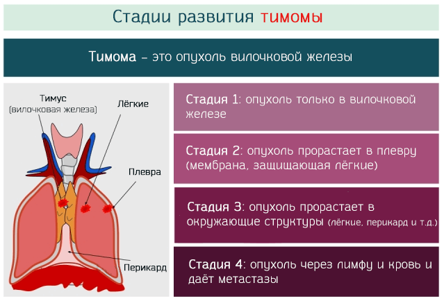 stadii стадии развития тимомы
