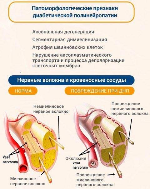 диабетическая полинейропатия симптомы