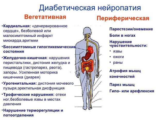 Виды полинейропатии