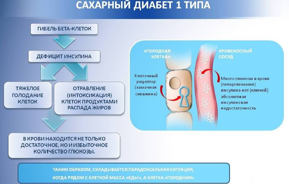 сахарный диабет 1 типа