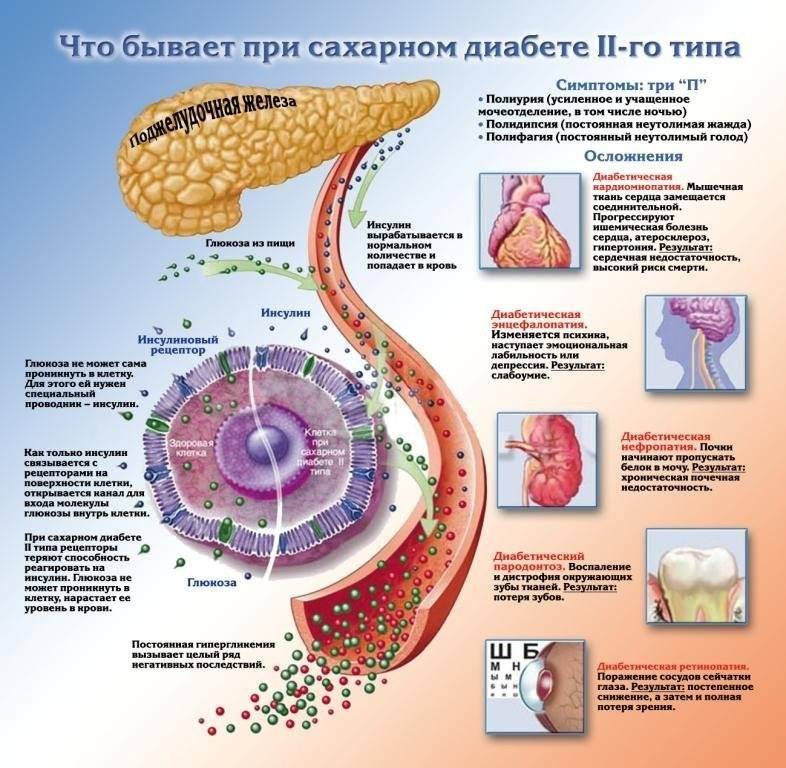 Сахарный диабет 2 типа