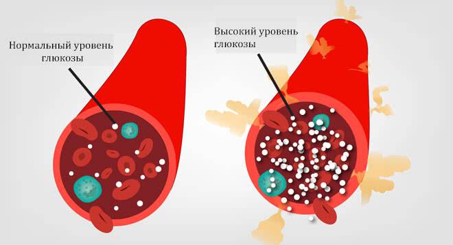 Уровень глюкозы в крови