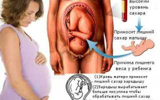 Гестационный сахарный диабет — диабет у беременных