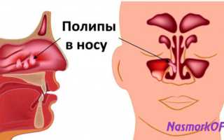 Как проводится удаление полипов в носу лазером
