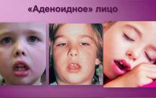 Физиотерапия при аденоидах у детей: виды процедур и эффективность лечения