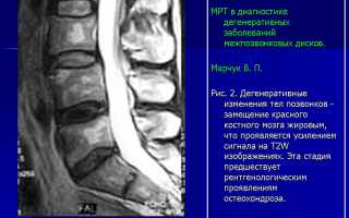 Жировая дегенерация костного мозга: что это такое и почему она происходит