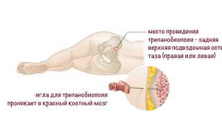 Трепанобиопсия костного мозга: суть исследования