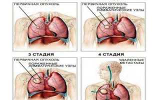 Курение при лечении рака