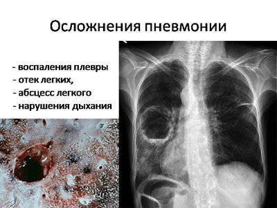 осложнения осложнения