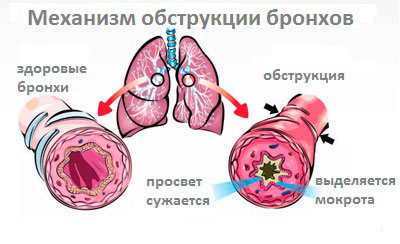 обструкция бронхов обструкция бронхов